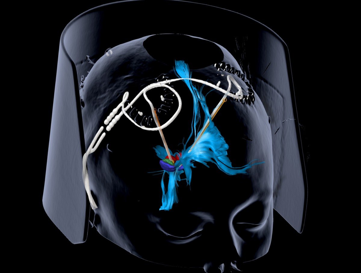 Tiefe_Hirnstimulation_Depresssion_UKF