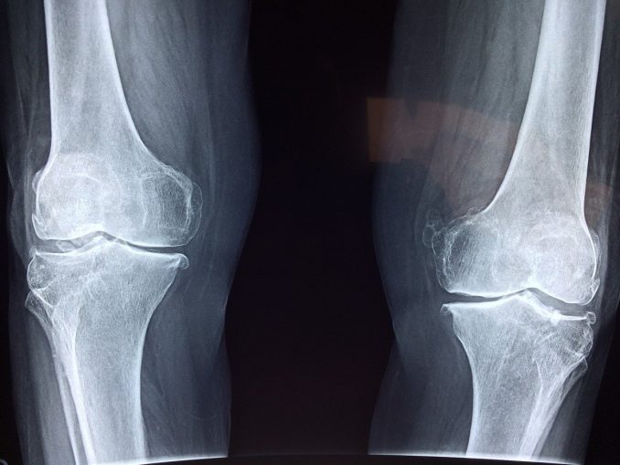 Arthrose