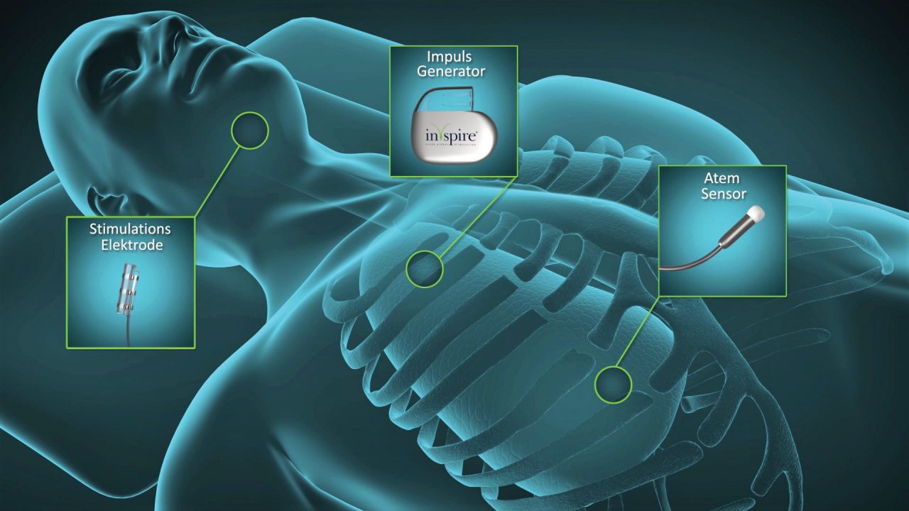 HNO-Zungenimplantat_1 HNO-Zungenimplantat_1