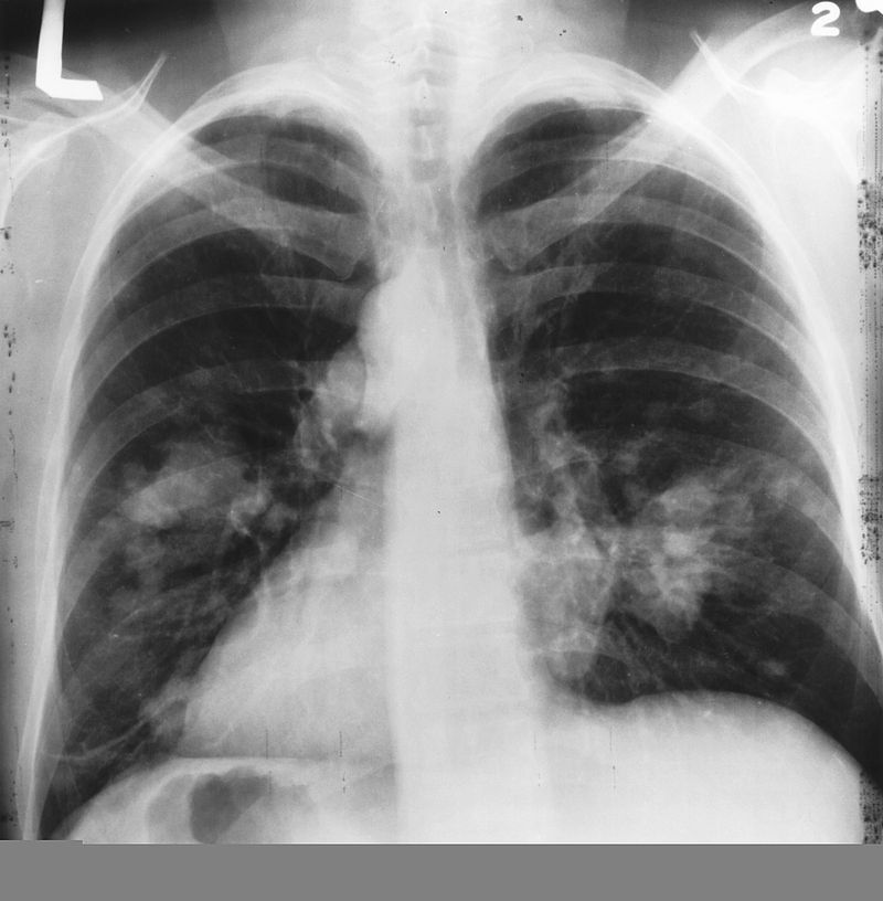 800px-X-ray(Chest)Cancer 800px-X-ray(Chest)Cancer